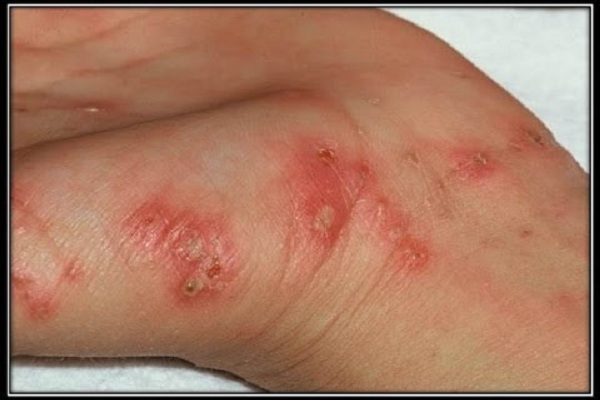 How can someone get rid of scabies?